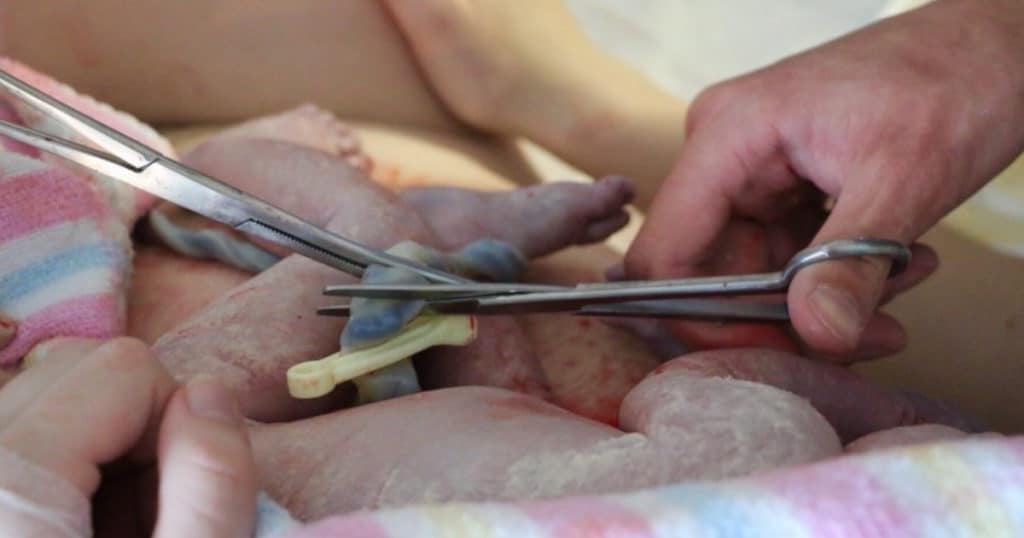 clamping and cutting a newborn umbilical cord